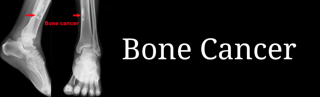 How ValAsta Helped Carol's Bone Cancer