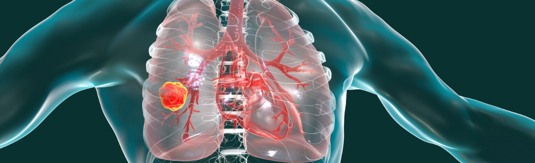 Lung Cancer isn’t Just for Smokers Anymore!